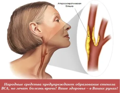 Минуще порушення мозкового кровообігу (минуще) Минуще порушення мозкового кровообігу
