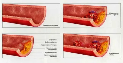 Продукти харчування й препарати, які розріджують кров і забирають тромбоз (кров) Продукти харчування й препарати, які розріджують кров і забирають тромбоз