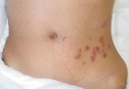 Плями після герпесу як прибрати плями і рубці на обличчі