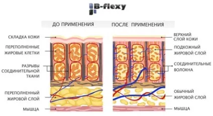 Процедура b-flexy