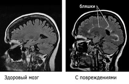 Розсіяний склероз - причини, симптоми, профілактика та лікування (лікування) Розсіяний склероз - причини, симптоми, профілактика та лікування