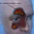 Рентгенографія придаткових пазух носа розшифровка, опис, фото (пазух) Рентгенографія придаткових пазух носа розшифровка, опис, фото