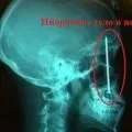 Рентгенографія придаткових пазух носа розшифровка, опис, фото (носа) Рентгенографія придаткових пазух носа розшифровка, опис, фото
