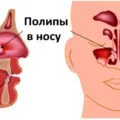 Рентгенографія придаткових пазух носа розшифровка, опис, фото (придаткових) Рентгенографія придаткових пазух носа розшифровка, опис, фото