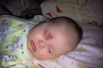 Рідні плями у новонароджених - види, спостереження, цікаві факти (плями) Рідні плями у новонароджених - види, спостереження, цікаві факти