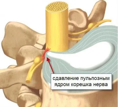 Різкий біль в попереку (праворуч або ліворуч) причини і її лікування (праворуч) Різкий біль в попереку (праворуч або ліворуч) причини і її лікування