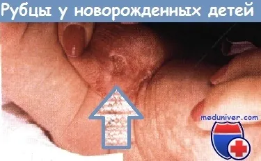 Рубці у новонароджених дітей