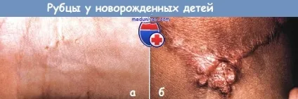 Рубці у новонароджених дітей
