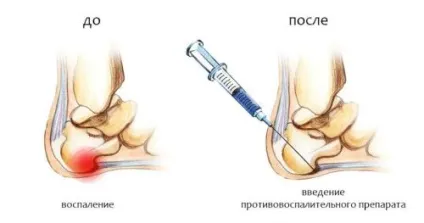 Вибираємо ефективну мазь для лікування п'яткової шпори (лікування п'яткової шпори) Вибираємо ефективну мазь для лікування п'яткової шпори