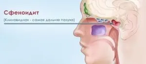 Сфеноїдит - що це таке, симптоми, лікування (фото, відео)