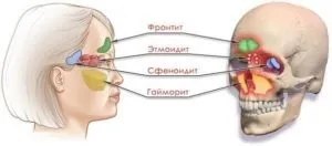Сфеноїдит - що це таке, симптоми, лікування (фото, відео)