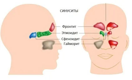 Сфеноїдит симптоми і лікування, причини розвитку гострого і хронічного сфеноїдити (сфеноідіт) Сфеноїдит симптоми і лікування, причини розвитку гострого і хронічного сфеноїдити