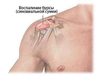 Симптоми і лікування бурситу плечового суглоба (бурситу) Симптоми і лікування бурситу плечового суглоба