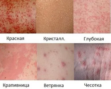 Висип на шиї у дорослого фото - модна красива