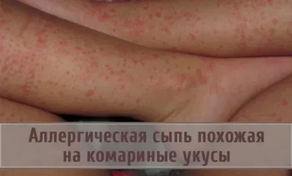 Висип у дитини схожа на укуси комарів, висип у дитини (комарів) Висип у дитини схожа на укуси комарів, висип у дитини