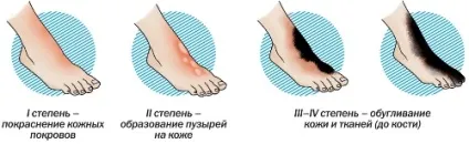 ступені опіків