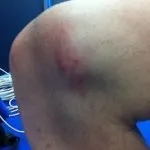 Травми колінного суглоба симптоми і лікування коліна (симптоми) Травми колінного суглоба симптоми і лікування коліна