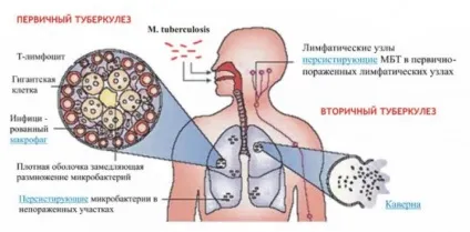 Туберкульоз - що це таке, причини, лікування, прогноз і результат (лікування) Туберкульоз - що це таке, причини, лікування, прогноз і результат