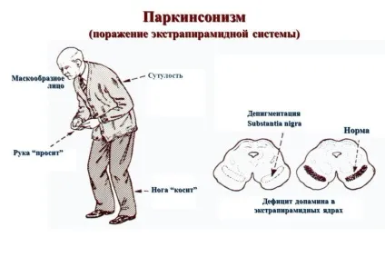 Тремор і алкоголь