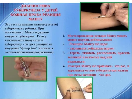 Туберкульоз - що це таке, причини, лікування, прогноз і результат (причини) Туберкульоз - що це таке, причини, лікування, прогноз і результат