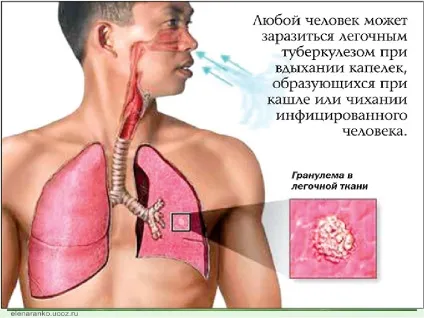 Туберкульоз - що це таке, причини, лікування, прогноз і результат (лікування) Туберкульоз - що це таке, причини, лікування, прогноз і результат