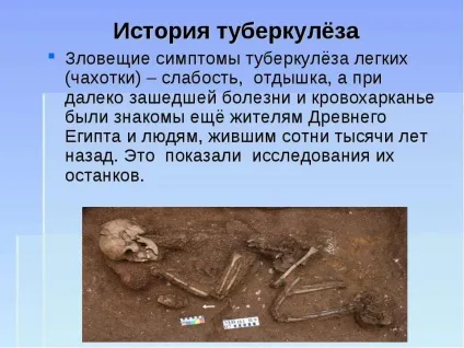 Туберкульоз - що це таке, причини, лікування, прогноз і результат (туберкульоз) Туберкульоз - що це таке, причини, лікування, прогноз і результат