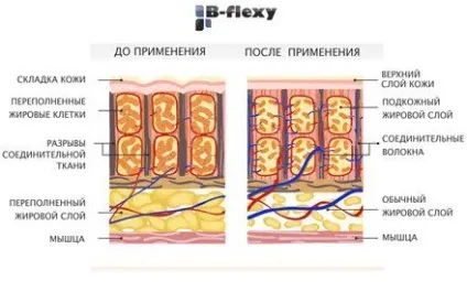 Вакуумно роликовий масаж b flexy в боротьбі з целюлітом (масаж домашніх умовах) Вакуумно роликовий масаж b flexy в боротьбі з целюлітом