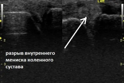 Узі колінного суглоба, протокол (протокол) Узі колінного суглоба, протокол