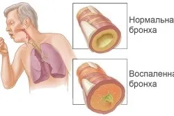Вірусний бронхіт у дорослих симптоми і лікування (захворювання Вірусний бронхіт) Вірусний бронхіт у дорослих симптоми і лікування