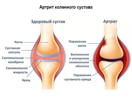 Вивих надколінка надання першої допомоги та лікування