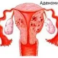 Запалення придатків симптоми і різні методи терапії (придатків) Запалення придатків симптоми і різні методи терапії