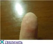 Водяні бульбашки навколо нігтя на руці, 2 відповідей, 38 коментарів, консультація-форум «дерматологія (навколо) Водяні бульбашки навколо нігтя на руці, 2 відповідей, 38 коментарів, консультація-форум «дерматологія