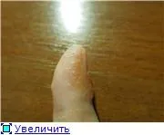 Водяні бульбашки навколо нігтя на руці, 2 відповідей, 38 коментарів, консультація-форум «дерматологія (навколо) Водяні бульбашки навколо нігтя на руці, 2 відповідей, 38 коментарів, консультація-форум «дерматологія