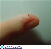 Водяні бульбашки навколо нігтя на руці, 2 відповідей, 38 коментарів, консультація-форум «дерматологія (бульбашки) Водяні бульбашки навколо нігтя на руці, 2 відповідей, 38 коментарів, консультація-форум «дерматологія