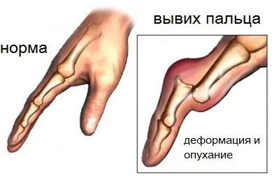 Вивих пальця на руці симптоми і лікування (пальця) Вивих пальця на руці симптоми і лікування