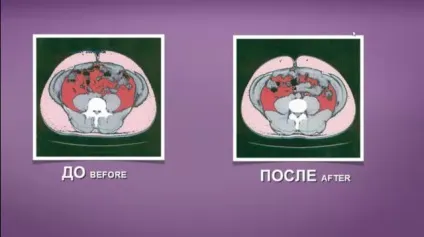 Вісцеральний жир як позбутися від жиру на животі чоловікам і жінкам (жиру) Вісцеральний жир як позбутися від жиру на животі чоловікам і жінкам