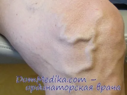 Хронічна венозна недостатність (ХВН) (хронічна венозна недостатність) Хронічна венозна недостатність (ХВН)