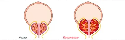 Хронічний простатит в стадії ремісії лікування і профілактика (ремісії) Хронічний простатит в стадії ремісії лікування і профілактика