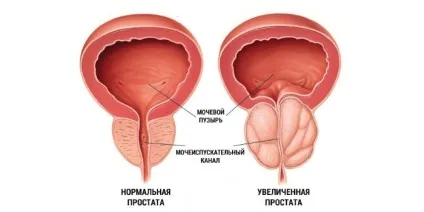 Хронічний простатит в стадії ремісії - як домогтися результату