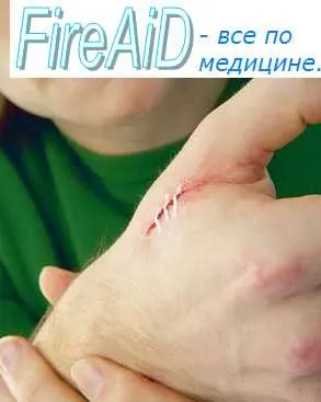 Загоєння рани первинним натягом (під струпом) Загоєння рани первинним натягом