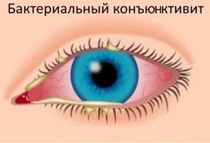 Заразний чи ні кон'юнктивіт і чи можна заразитися від людини або кішки (заразитися) Заразний чи ні кон'юнктивіт і чи можна заразитися від людини або кішки