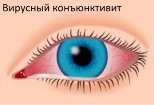 Заразний чи ні кон'юнктивіт і чи можна заразитися від людини або кішки (кон'юнктивіт) Заразний чи ні кон'юнктивіт і чи можна заразитися від людини або кішки