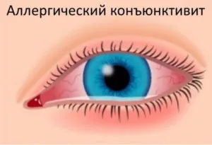 Заразний чи ні кон'юнктивіт і чи можна заразитися від людини або кішки (людини) Заразний чи ні кон'юнктивіт і чи можна заразитися від людини або кішки