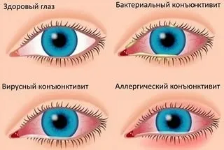 Заразний чи ні кон'юнктивіт і чи можна заразитися від людини або кішки (заразитися) Заразний чи ні кон'юнктивіт і чи можна заразитися від людини або кішки