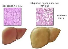 Жирова дегенерація печінки