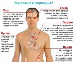 Злоякісна гіпертонія - що це, симптоми і методи лікування (методи) Злоякісна гіпертонія - що це, симптоми і методи лікування
