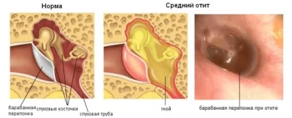 Рідина в вусі за барабанною перетинкою у дитини або дорослого лікування (як довго йде рідина за барабанною перетинкою) Рідина в вусі за барабанною перетинкою у дитини або дорослого лікування