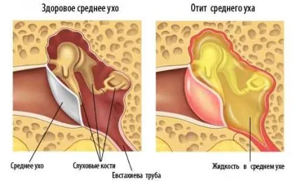 Рідина в вусі за барабанною перетинкою у дитини лікування (перетинкою) Рідина в вусі за барабанною перетинкою у дитини лікування