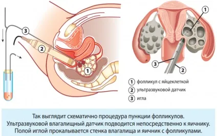 Аденоміоз матки - що це таке симптоми і лікування при вагітності (симптоми) Аденоміоз матки - що це таке симптоми і лікування при вагітності