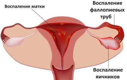 Аденоміоз матки - що це таке симптоми і лікування при вагітності (таке) Аденоміоз матки - що це таке симптоми і лікування при вагітності